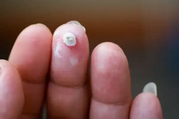 Image of white wart before cryopen treatment Shoreditch