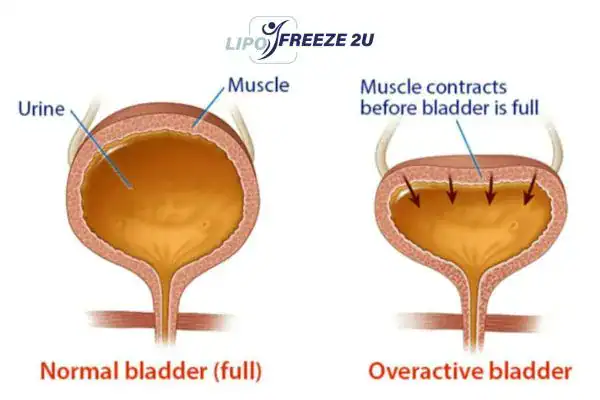 diagram of overactive bladder treatment Shoreditch