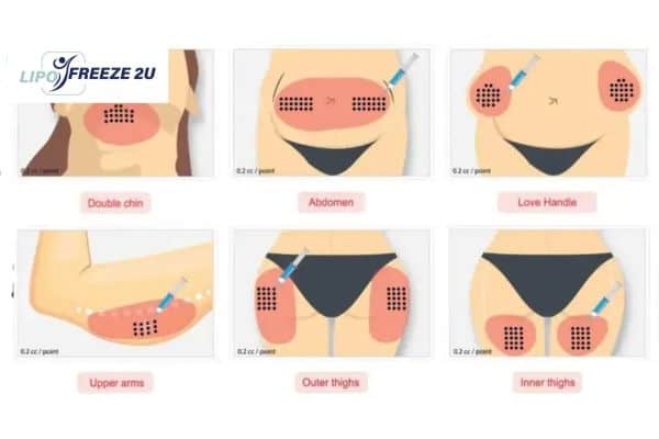 Benefits of Choosing Aqualyx for Fat Reduction Shoreditch