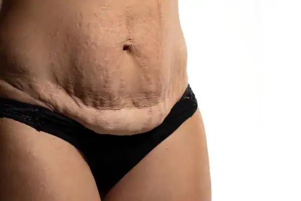 loose skin after weight loss injections Shoreditch