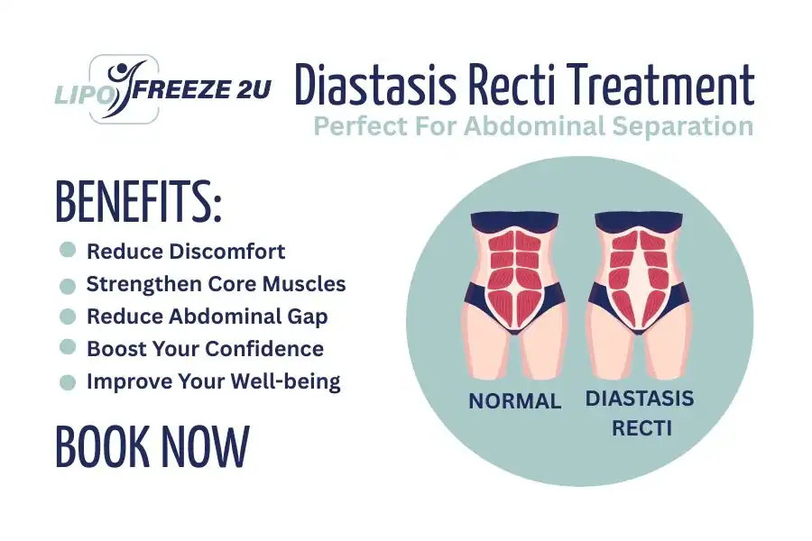 How Long Will It Take to See Improvements in Diastasis Recti Shoreditch