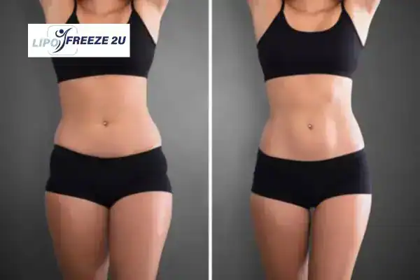 How Can LIPO FREEZE 2U Support Your Post-Pregnancy Body Recovery Shoreditch?