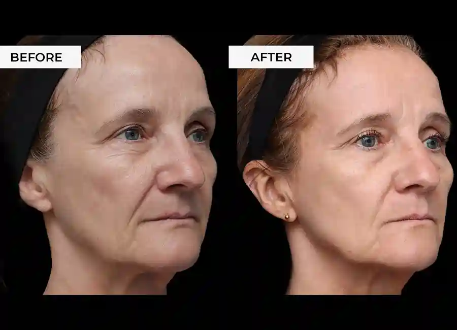How Many RF Microneedling Sessions Will You Need to See a Difference Shoreditch?